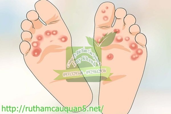 C&aacute;c bệnh về da g&acirc;y ra m&ugrave;i h&ocirc;i gi&agrave;y